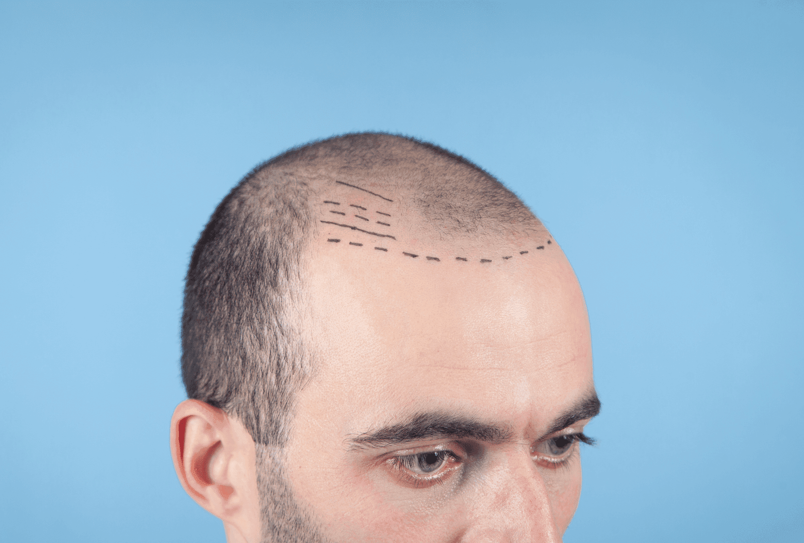 Greffe de cheveux sur un homme
