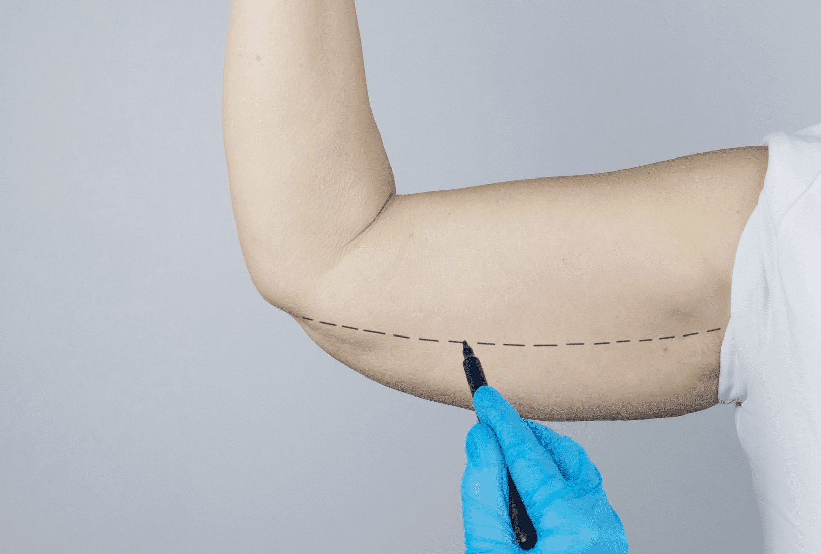 Lifting des bras - chirurgie esthétique