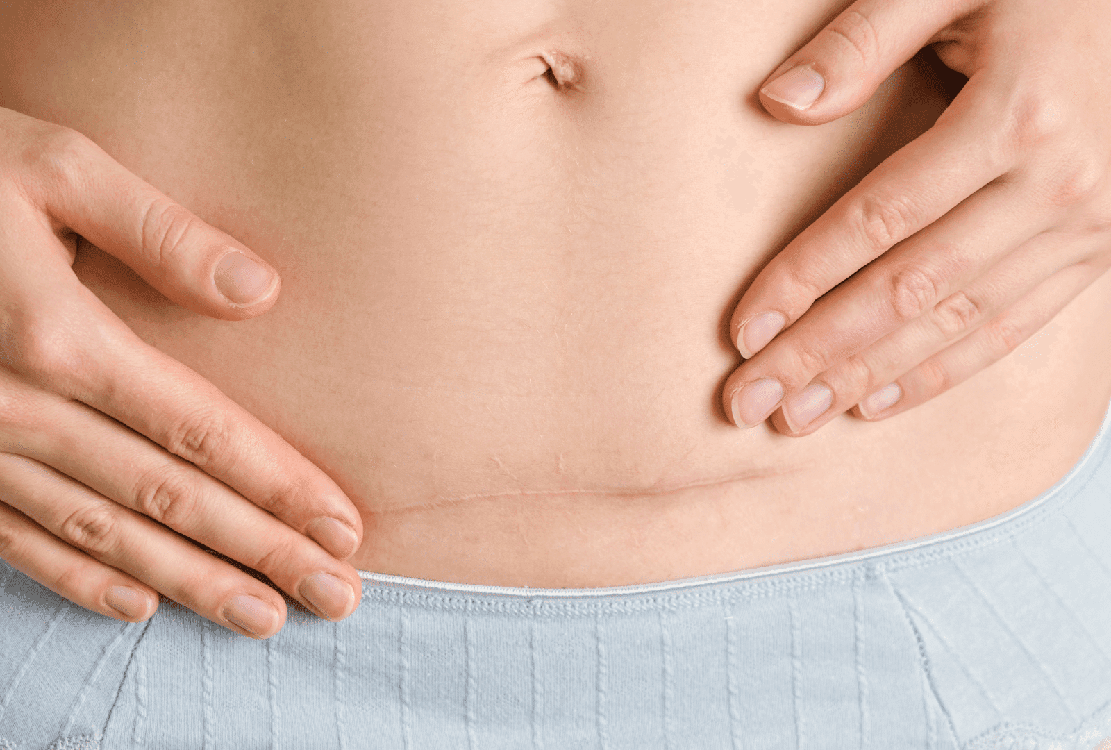 Chirurgie mommy makeover