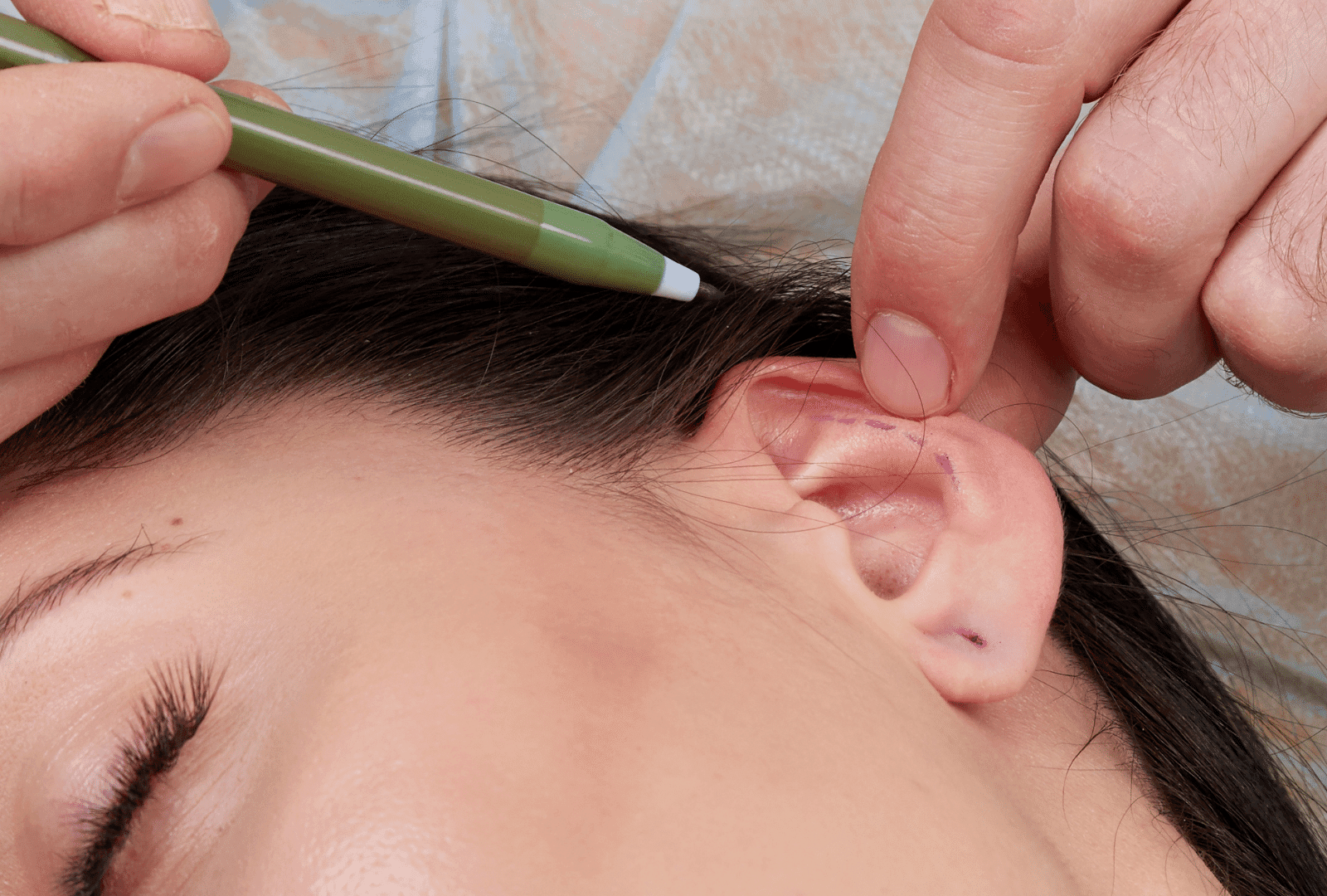 Otoplastie oreilles - chirurgie esthétique