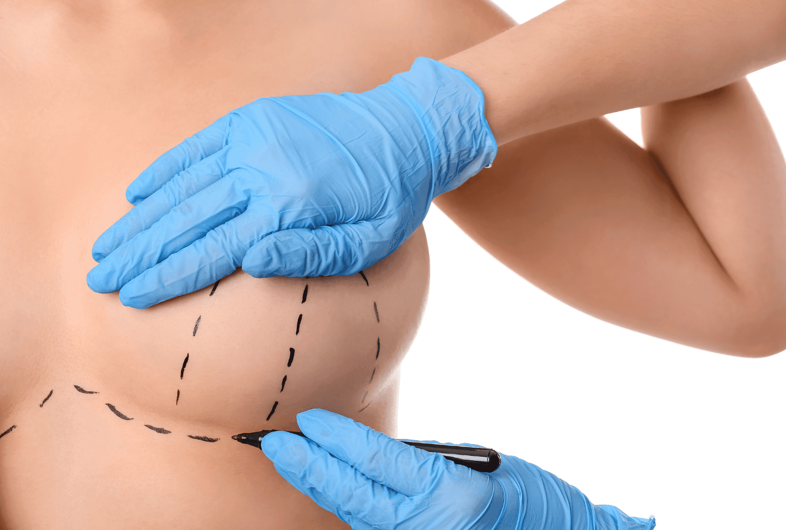 Augmentation mammaire