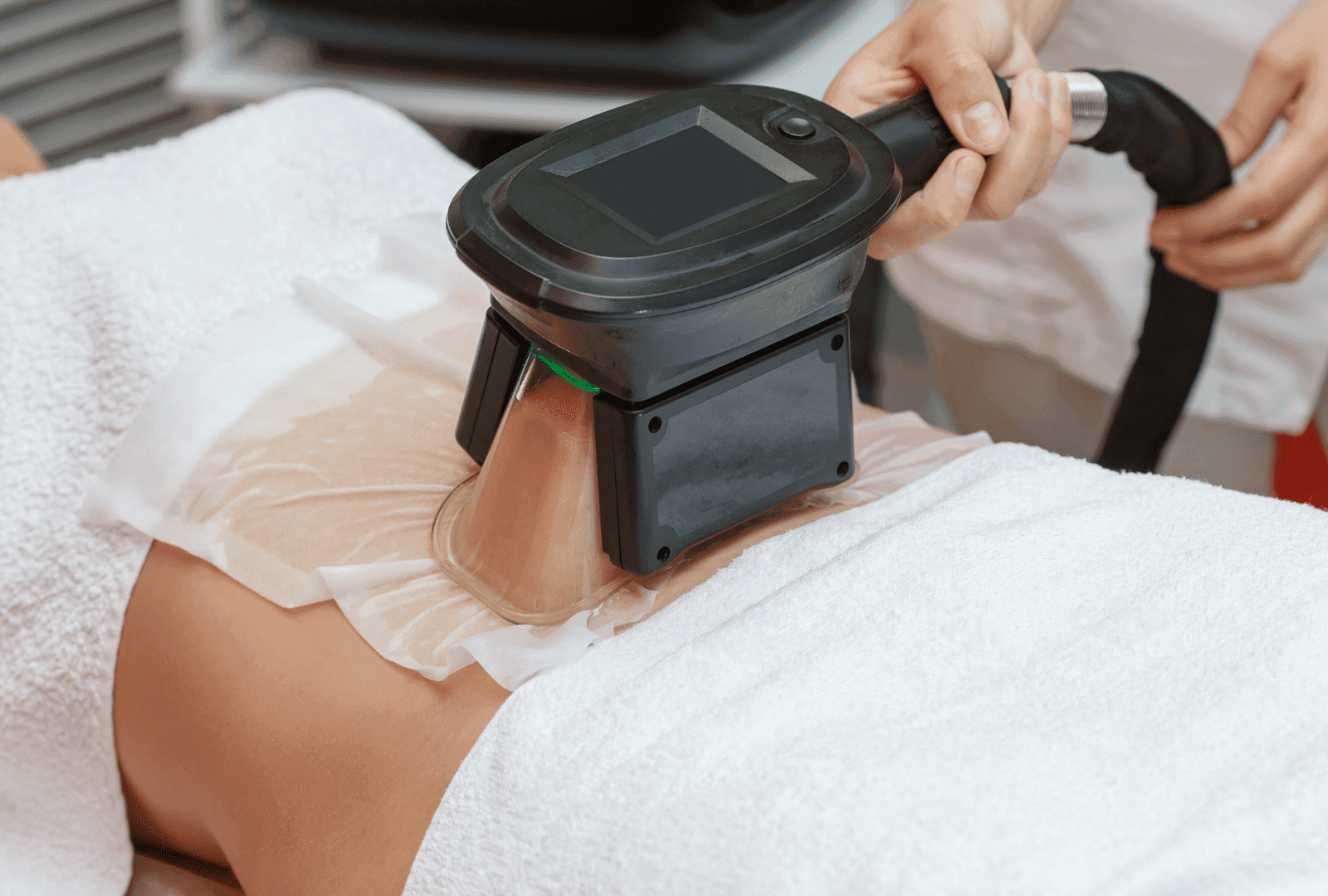 Cryolipolyse sur une zone abdominale