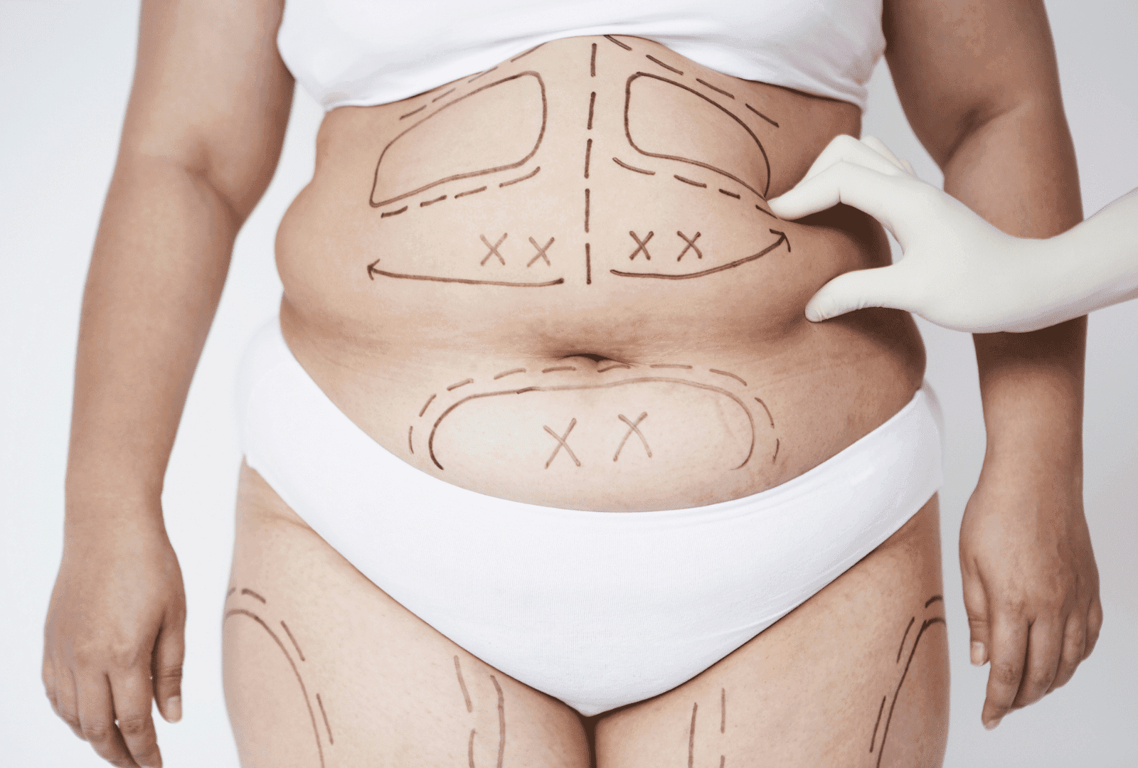 Liposuccion