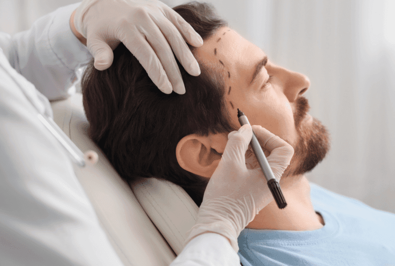 Greffe de cheveux chez un homme avec implantation de greffons sur la ligne frontale