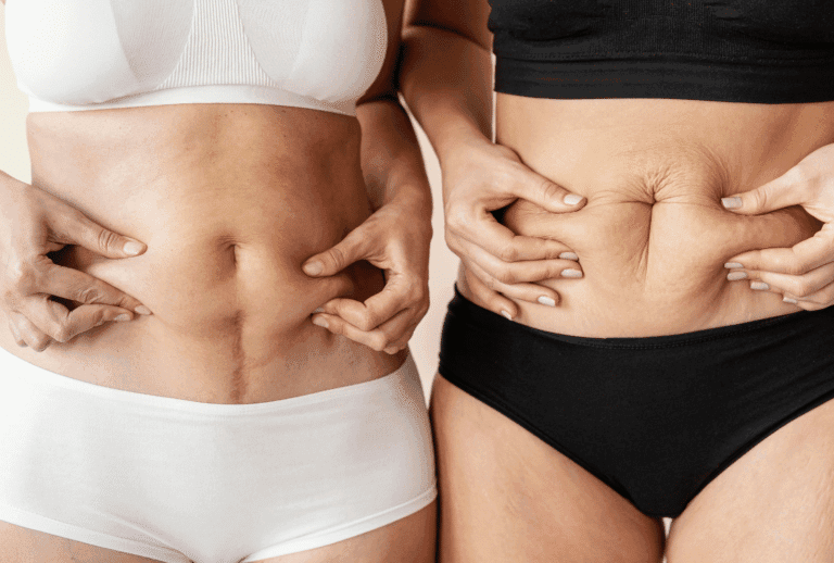Comparaison de deux abdomens montrant un excès de peau abdominale, indication pour une abdominoplastie