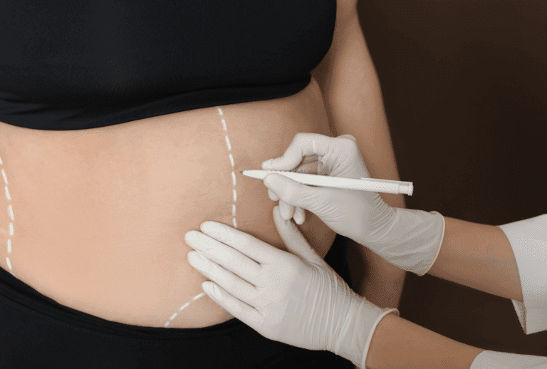 Marquage préopératoire avant une liposuccion de l’abdomen chez une femme