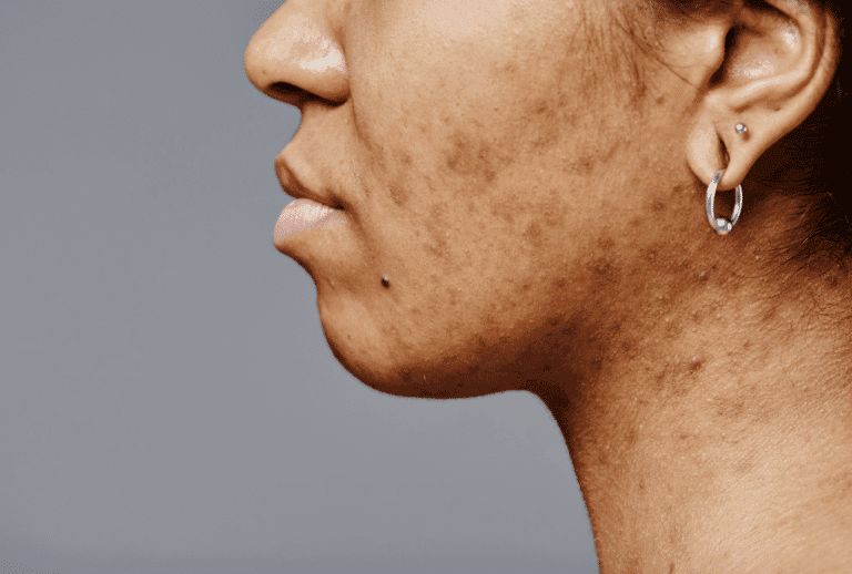 Profil d'une personne avec des imperfections cutanées