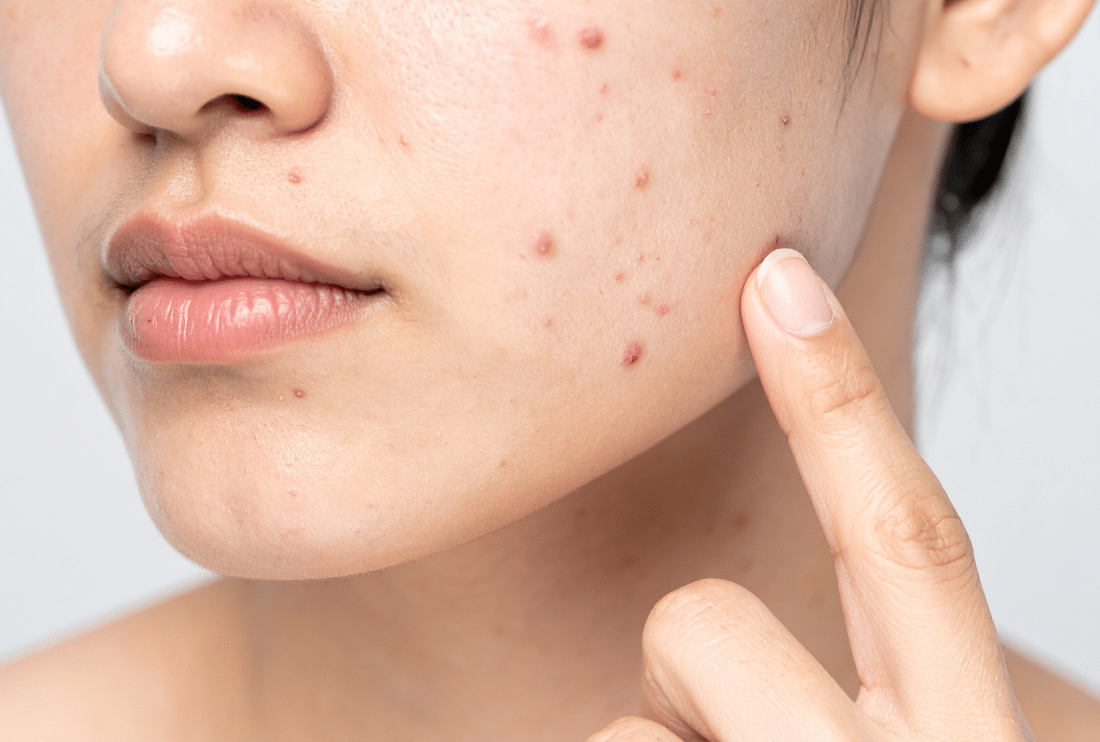 Peau du visage présentant de l’acné, avec une femme montrant les boutons à traiter.