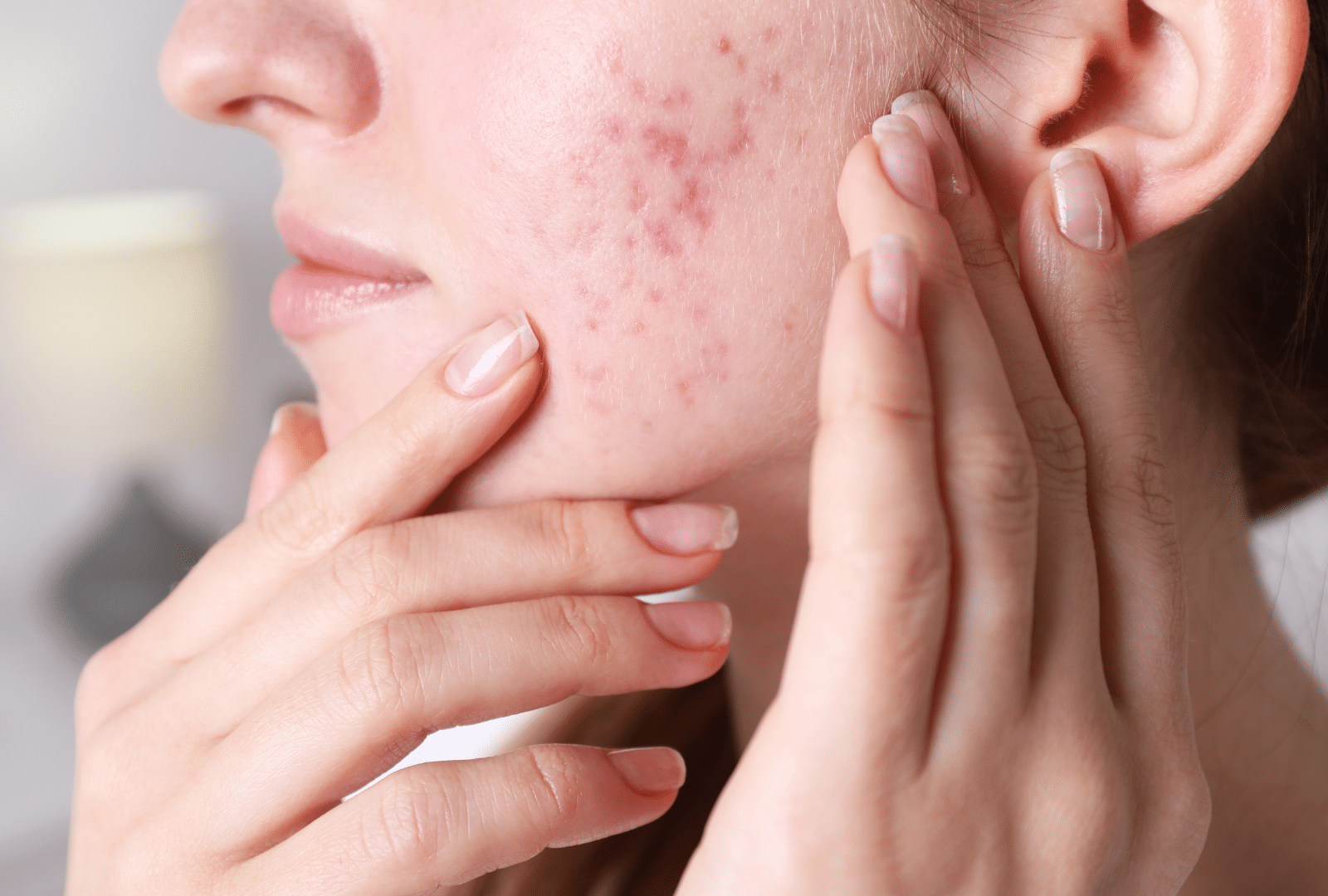 Peau du visage marquée par des cicatrices d’acné visibles sur la joue.