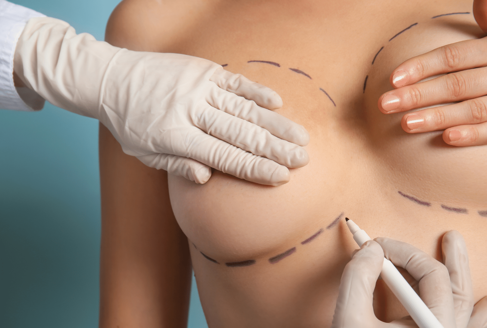 Marquage de la poitrine avant une intervention chirurgicale