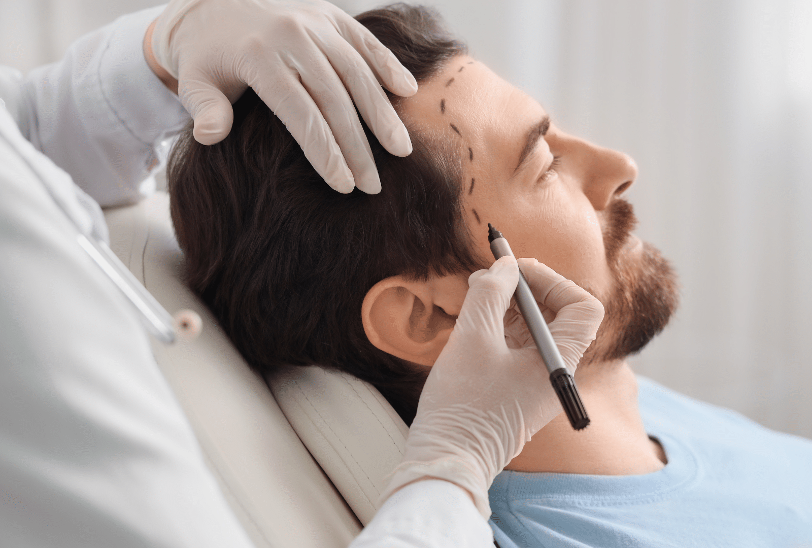 Prix et greffons : comment est calculé le devis d’une greffe de cheveux en Suisse ?