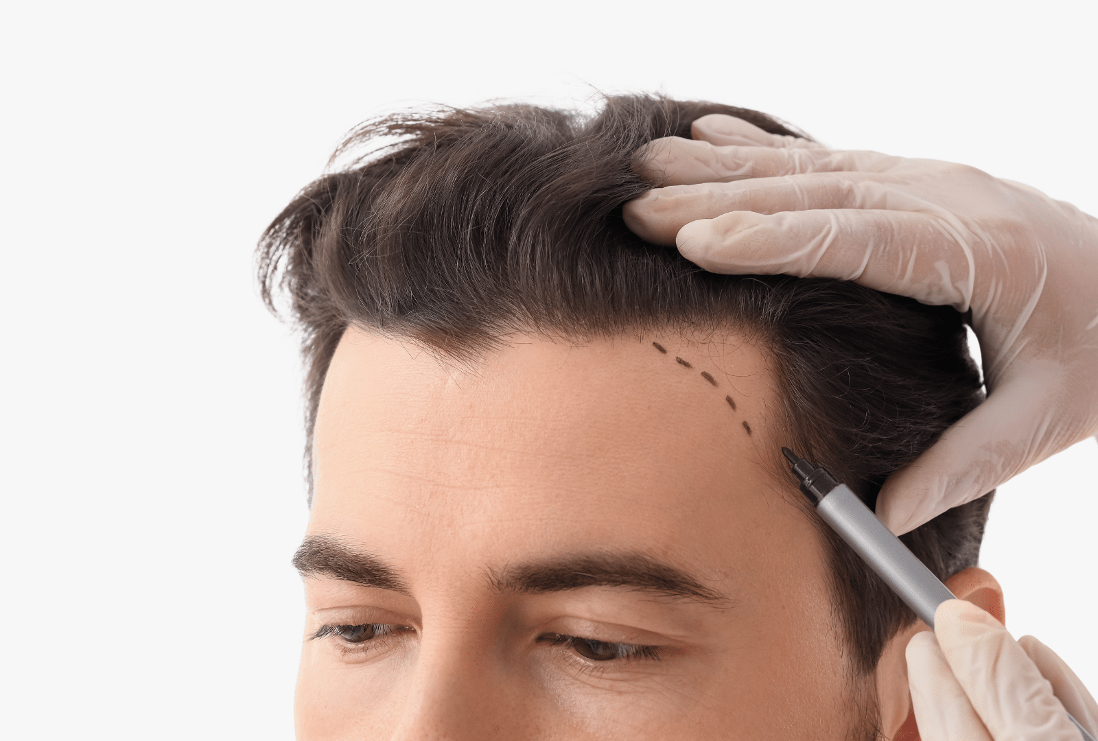 Homme en consultation pour greffe de cheveux avec tracé de la ligne frontale