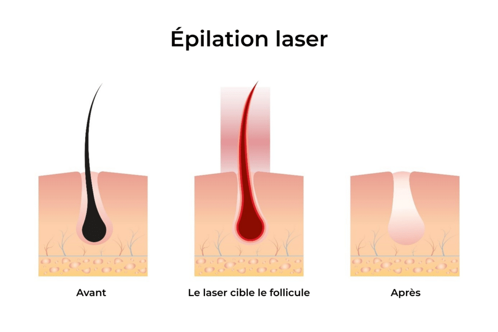 Schéma explicatif de l’épilation laser montrant le follicule avant, pendant et après le traitement