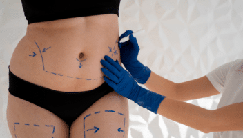 Marquage médical sur l’abdomen et les cuisses d’une femme avant un traitement de remodelage corporel