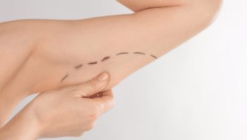 Marquage préopératoire d’un lifting des bras pour retirer l’excès de peau