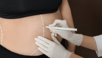 Marquage préopératoire avant une liposuccion de l’abdomen chez une femme