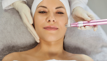 Traitement de la peau avec un dispositif de microneedling.