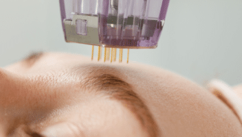 Traitement de la peau avec un dispositif microneedling.
