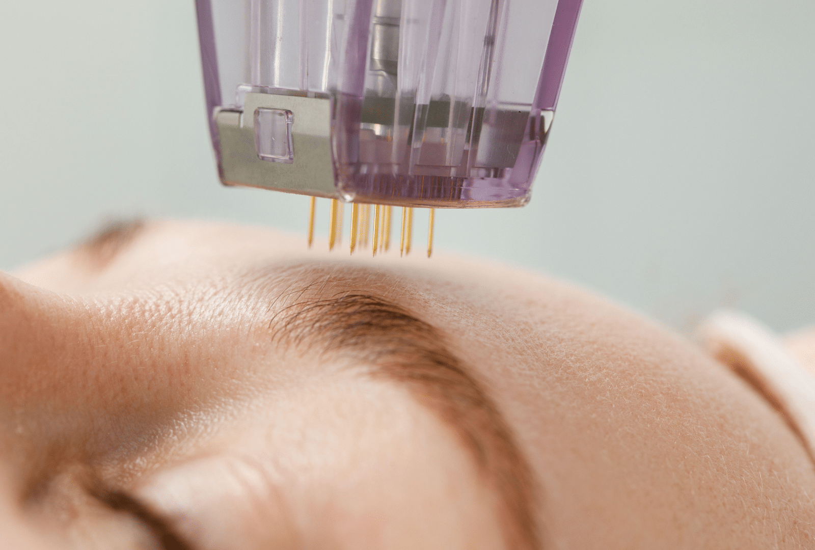 Traitement de la peau avec un dispositif microneedling.
