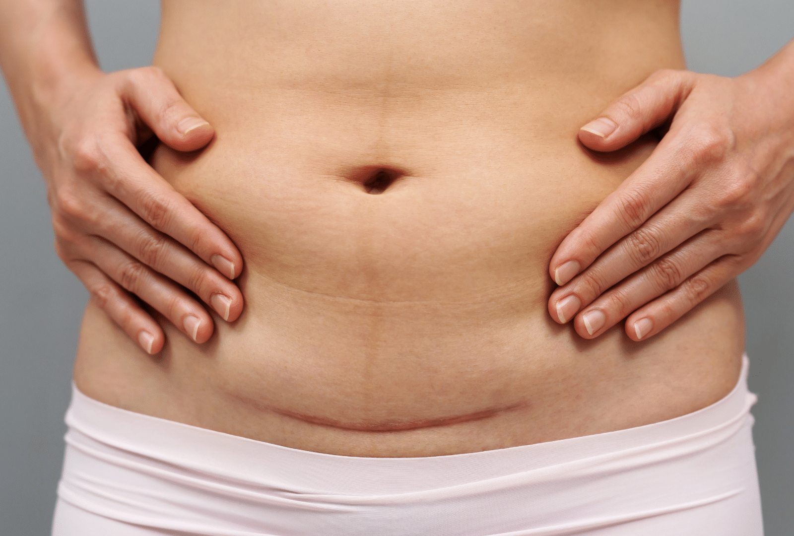 Ventre féminin présentant une cicatrice de césarienne