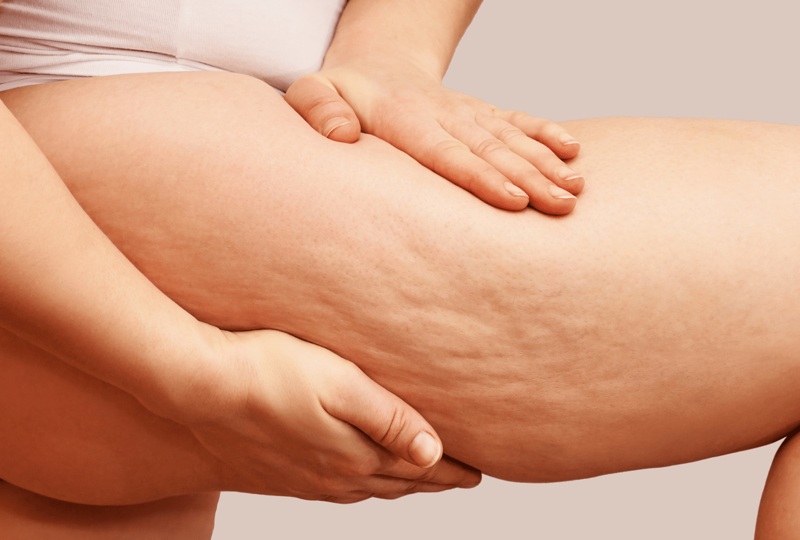 Main touchant une cuisse avec vergetures.