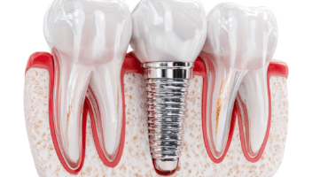 Modèle de dents avec implant dentaire