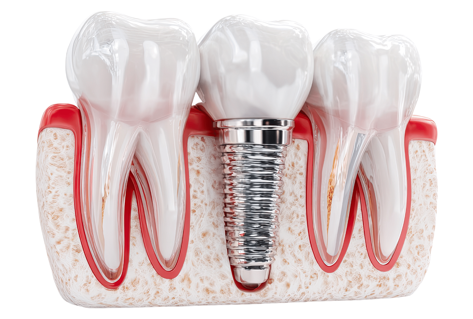 Modèle de dents avec implant dentaire