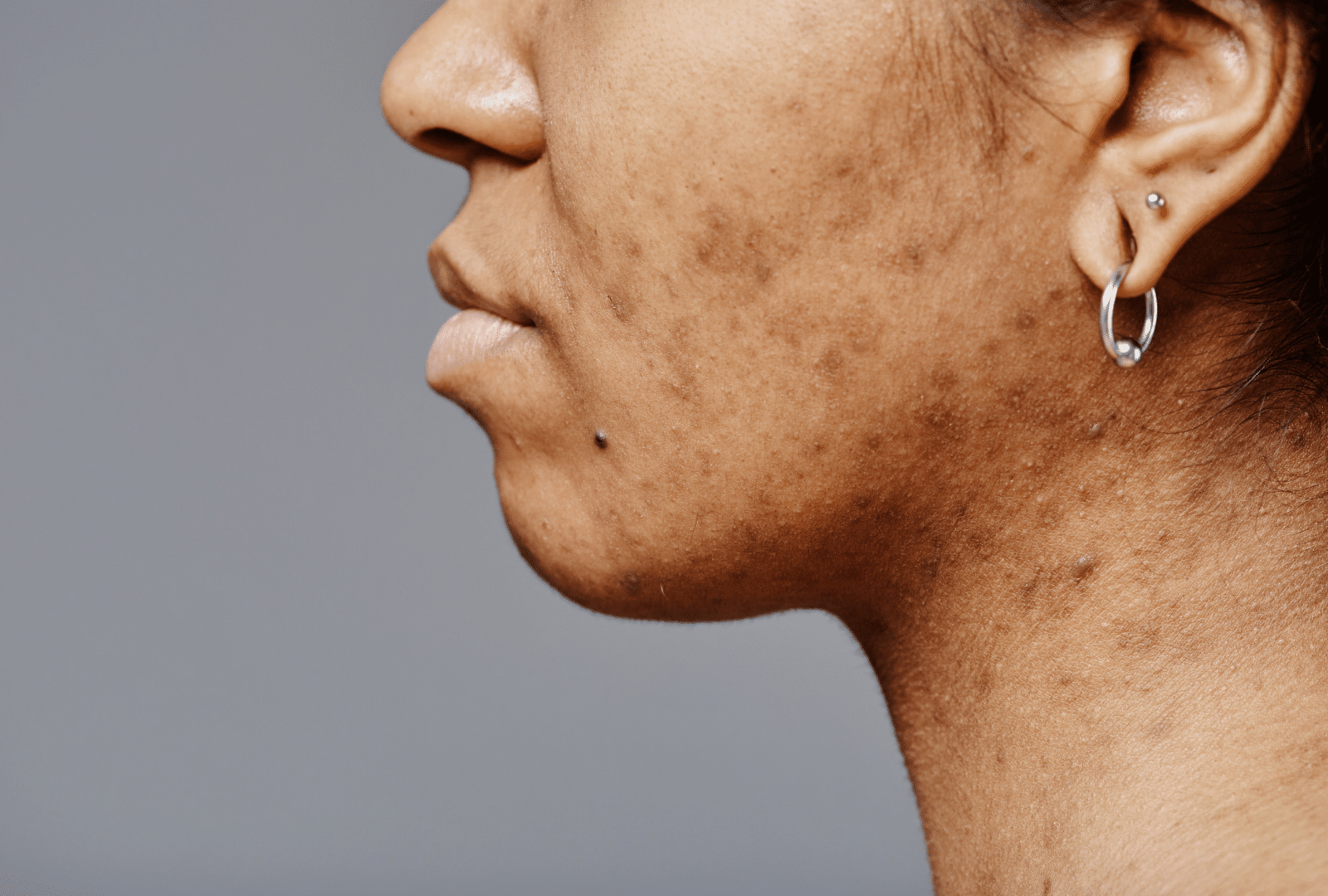 Profil d'une personne avec des imperfections cutanées