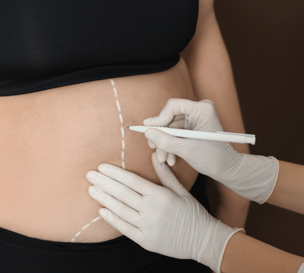 Marquage préopératoire avant une liposuccion de l’abdomen chez une femme